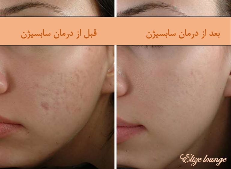 full face subcision