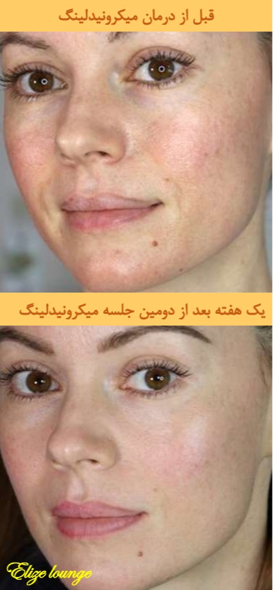 before and after microneedling treatment