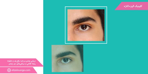 the-beauty-of-men's-eyes;-Removing-puffiness-and-crow's-feet-lines-and-dark-circles-around-the-eyes
