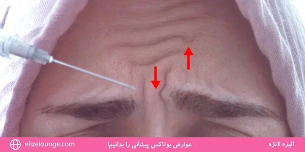 Know-the-side-effects-of-forehead-Botox