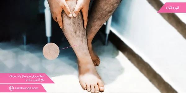 Treatment-of-leg-hair-loss-in-men;-Fix-leg-alopecia