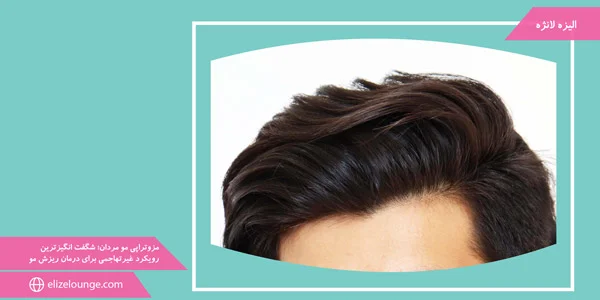 Men's-hair-mesotherapy;-The-most-amazing-non-invasive-approach-to-hair-loss-treatment