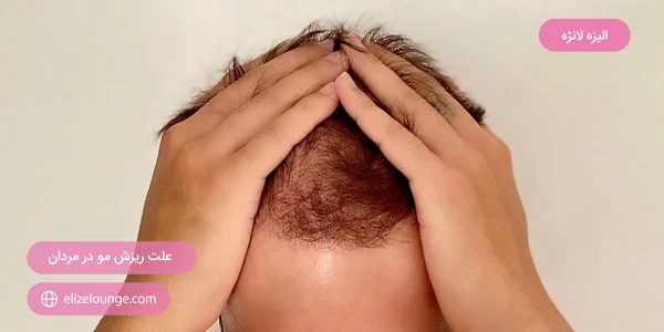 Causes-of-hair-loss-in-men