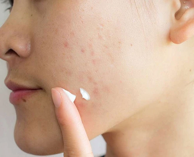 Cream-remove-pimples