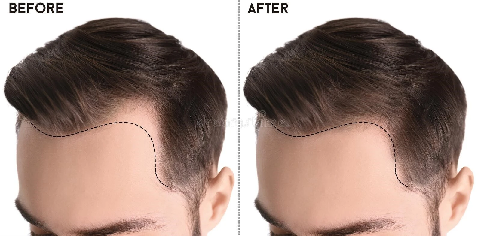 Definitive-treatment-hair-loss-men