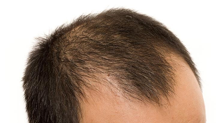 الگوی ریزش مو مردانه؛ تشخیص علت ریزش مدام موها و رفع همیشگی آن