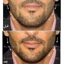 Mens-chin-gel-injection