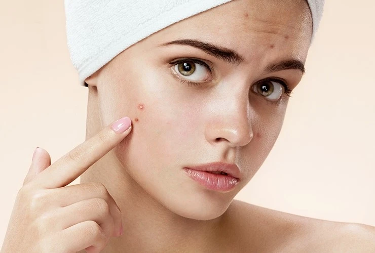 Soap-remove-acne