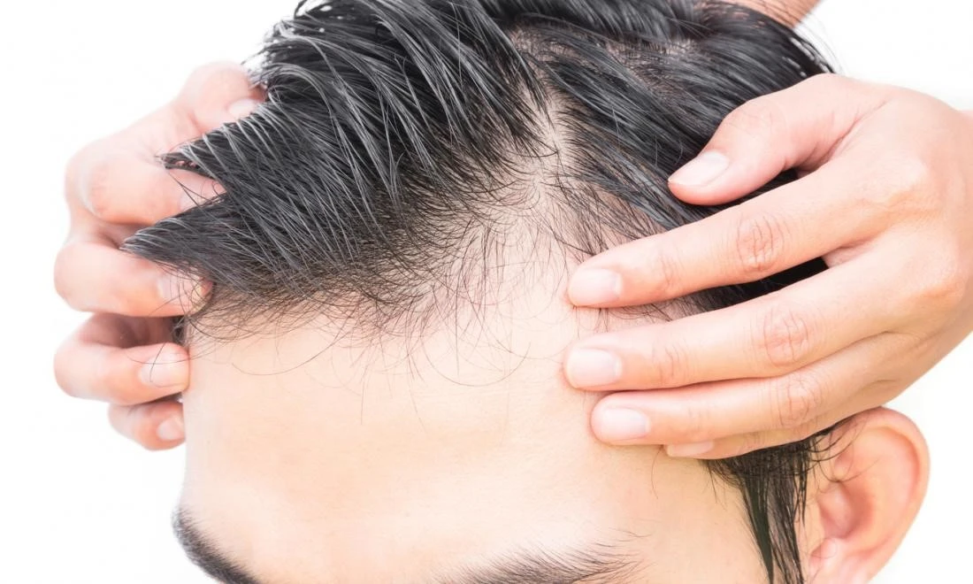 Treatment-hormonal-hair-loss-men