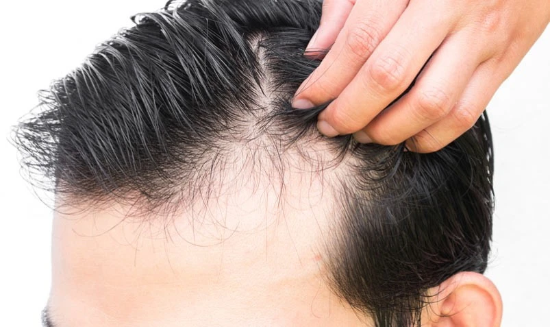 Treatment-male-hair-loss-traditional-medicine