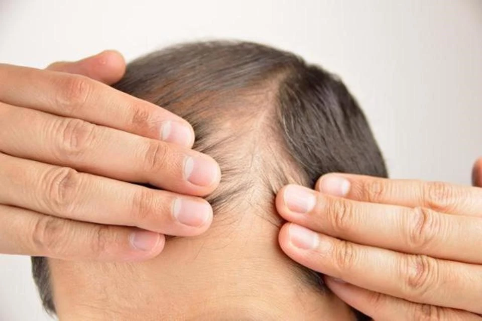Treatment-male-pattern-baldness