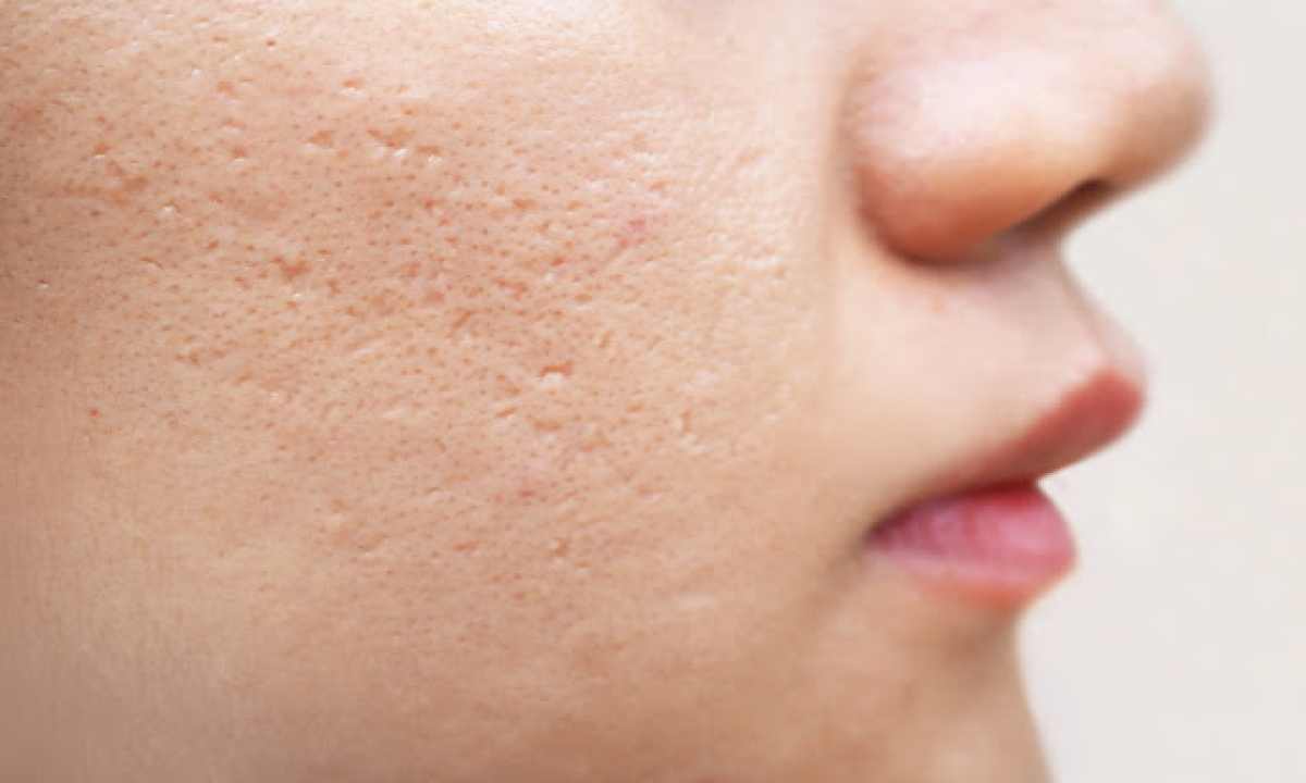 جای جوش روی صورتم مونده 