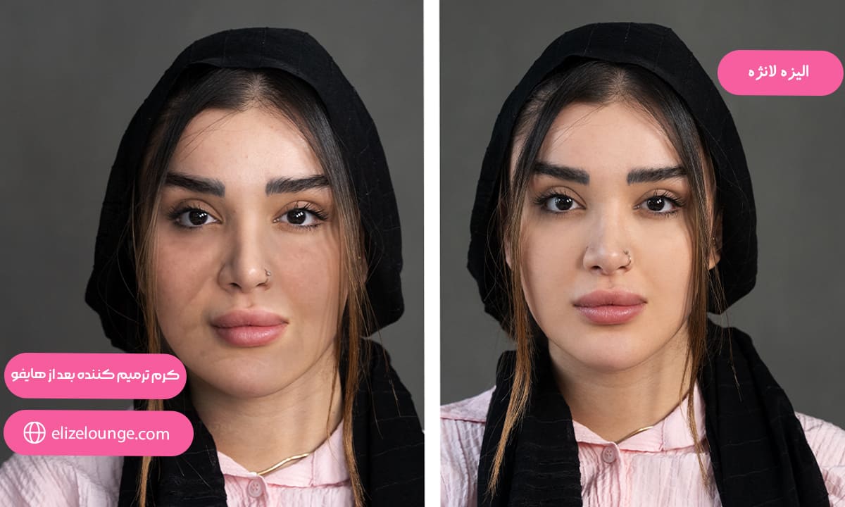 کرم ترمیم کننده بعد از هایفو