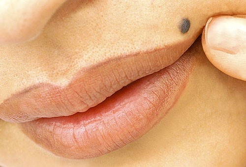 از بین بردن خال صورت در یک روز در خانه